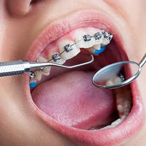 Braces — Dental Care in QLD